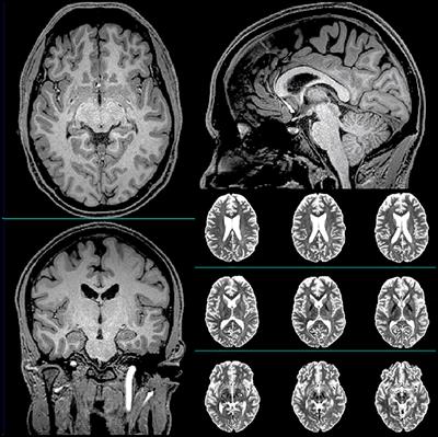 Changes in Brain Function and Structure After Self-Administered Home Photobiomodulation Treatment in a Concussion Case